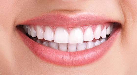 The same smile after professional whitening, several shades brighter
