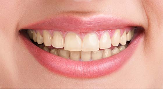 Close-up of a smile before professional whitening, with noticeable yellow surface stains
